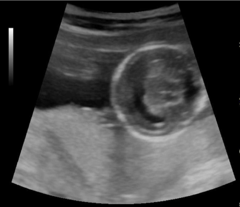 <p>____ is displayed and it’s a common finding </p><p>a) aqueductal stenosis, trisomy 21</p><p>b) alobar holoprosencephaly, trisomy 13</p><p>c) dandy walker malformation, spina bifida</p><p>d) lobar holoprosencephaly, monosomy x</p>