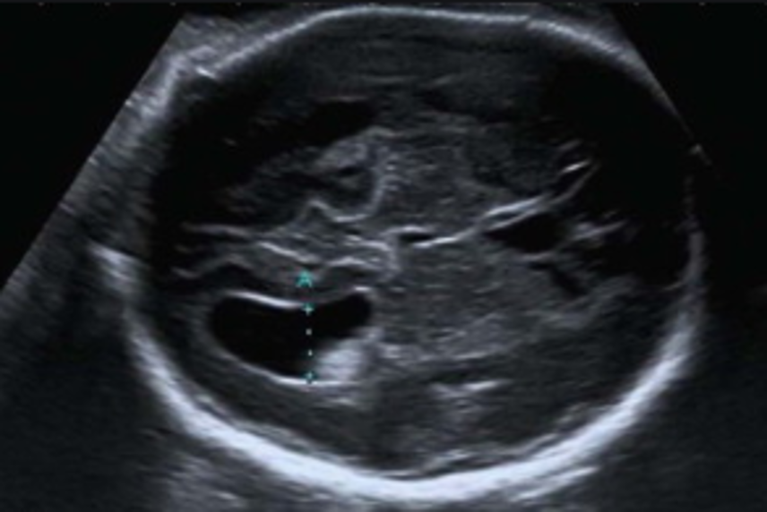 <p>hydrocephalus (image is dilated!) </p>