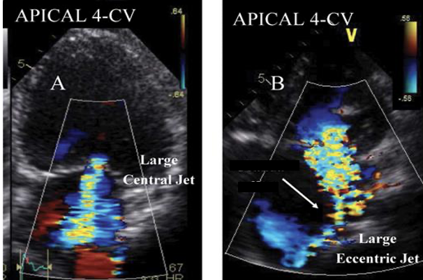 <p>The ___________is when a regurgitation jet “wraps around” (or hug) the Lt atrial wall.</p>