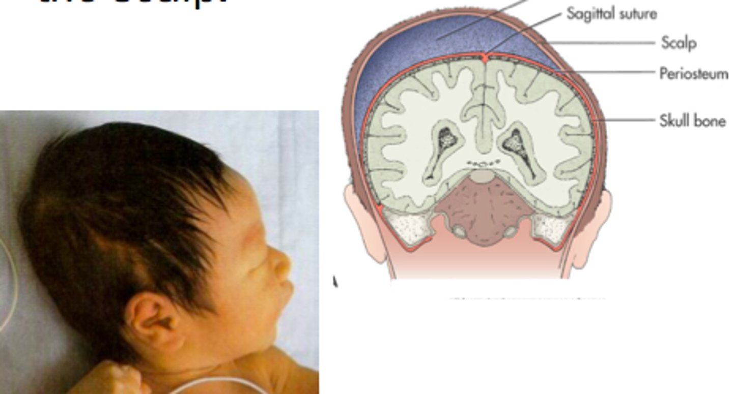 <p>crosses suture lines</p>