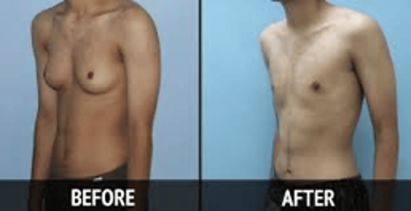 <p>enlargement of breast tissue in males - harder to identify in larger men but will have other signs like the nipple</p>