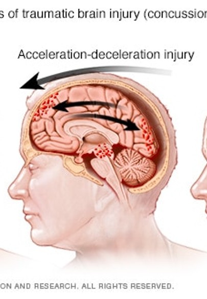 <p>happens when brain rapidly shifts inside the skull— injury occurs during acceleration/deceleration </p>