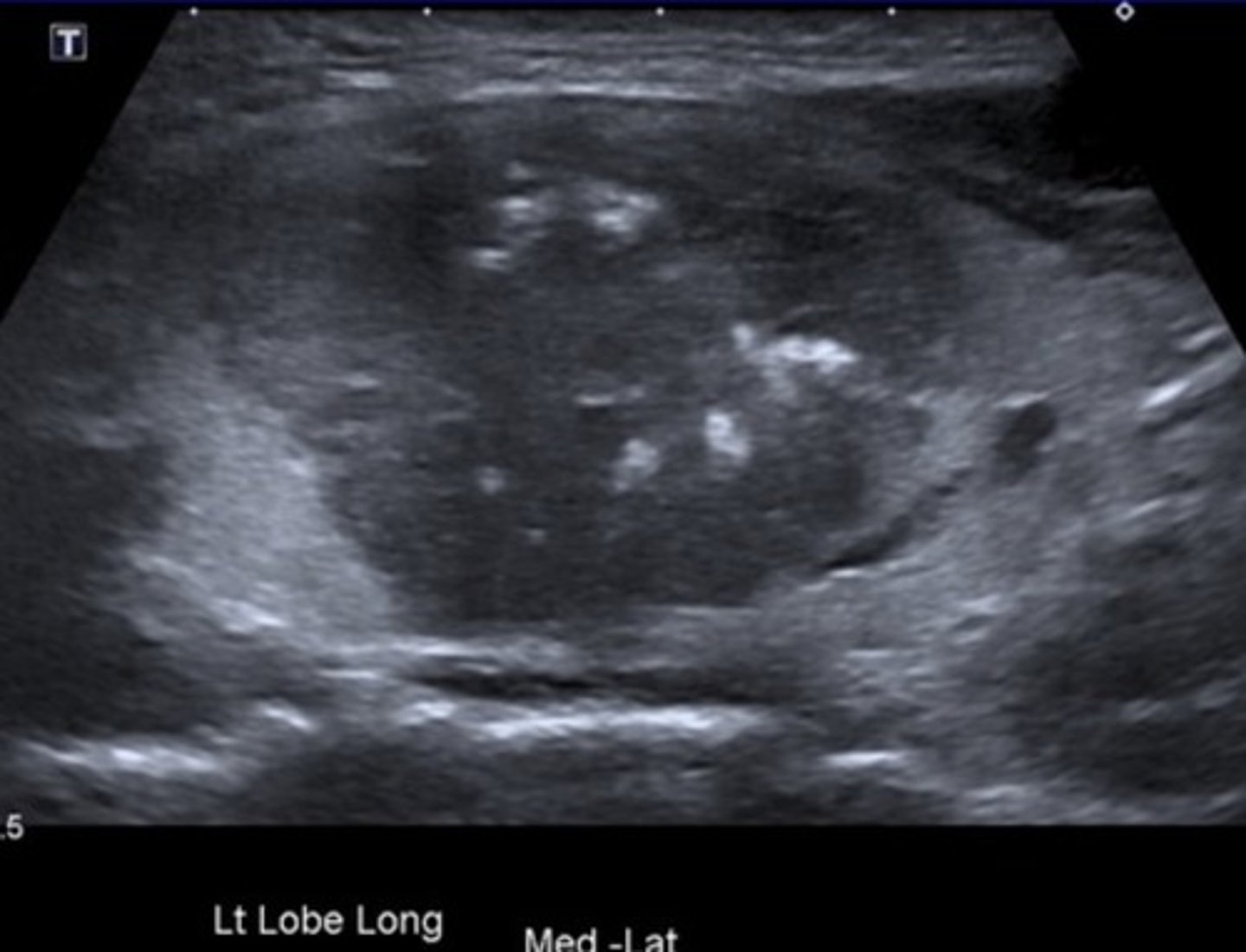 <p>Neuroendocrine tumor</p><p>Can be sporadic or familial</p>