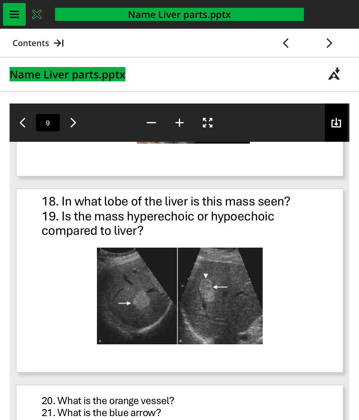 <ol start="18"><li><p>in what lobe of the liver is this mass seen </p></li></ol>