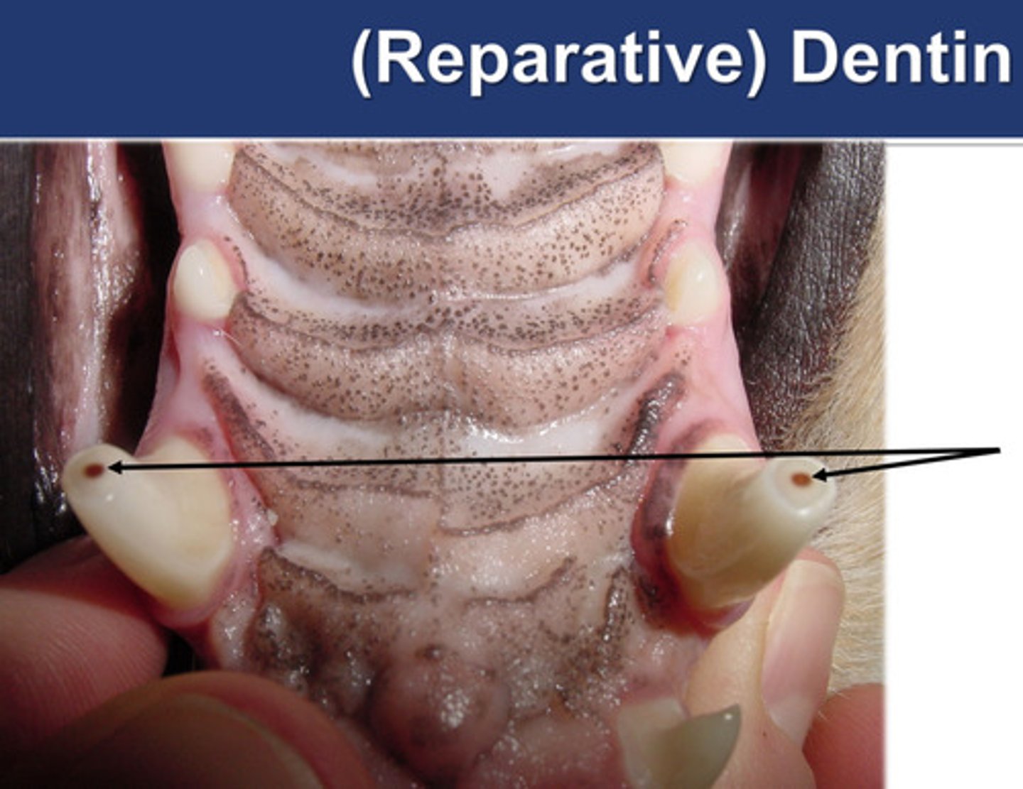 <p>[primary/secondary/tertiary] dentin is the reparative dentin. When enamel and dentin are gradually lost as the result of an insult (ex: mechanical wear), existing odontoblast-like cells produce this to protect the pulp.</p>