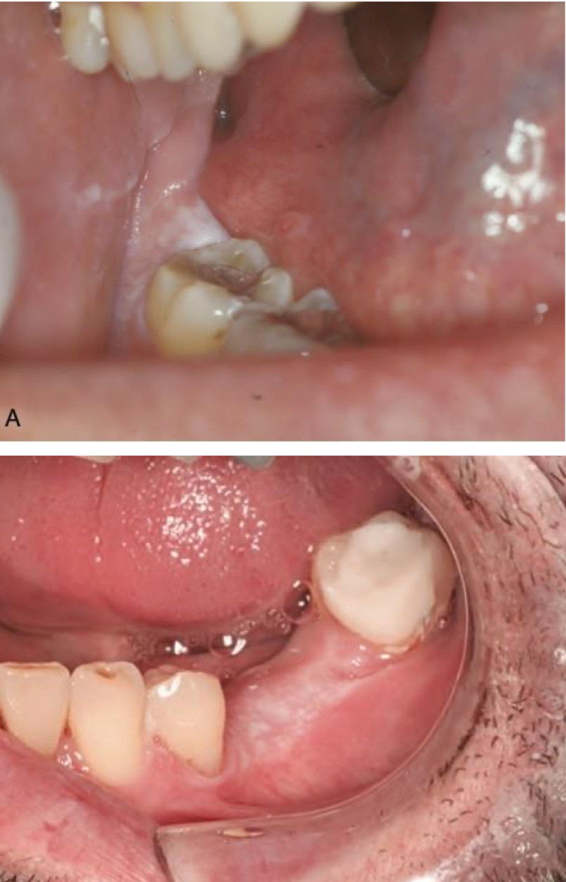 <p>which environmental/reactive lesion:</p><ul><li><p>Poorly demarcated, rough white plaque of the keratinized mucosa</p></li><li><p>Friction with food</p></li><li><p>Often confused with leukoplakia</p></li><li><p>No treatment required</p></li></ul><p></p>