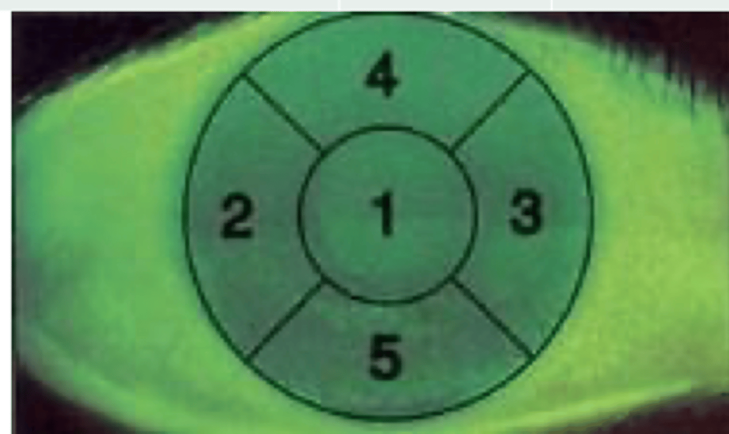 <p>Label #2-5 in a right eye vs left eye:</p>