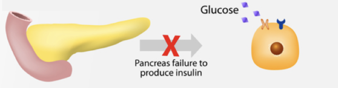 <ul><li><p><span>caused by the destruction of insulin-producing cells resulting in the body producing little or no insulin</span></p></li></ul><p></p>