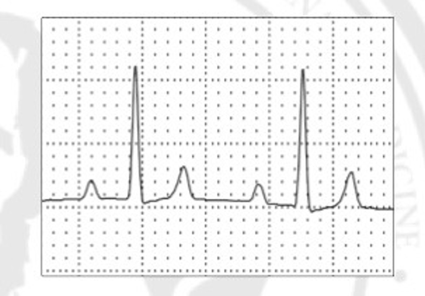 <p>What is the origin of this ECG?</p>