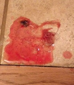 <p><strong>sudden onset of vomiting (<2 weeks)</strong> due to mucosal insult or inflammation </p><p>± hematemesis, dysrexia&nbsp;</p><p>abdominal pain and fever uncommon</p>