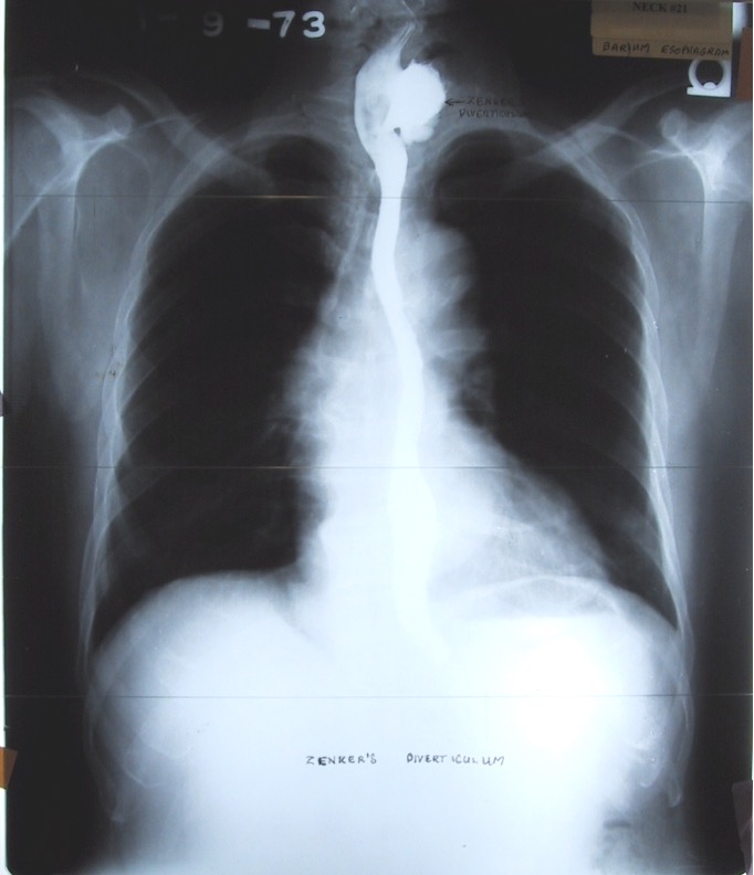 <p>out pouching of cervical esophagus that results form weakness in muscular wall; causes dysphagia</p>