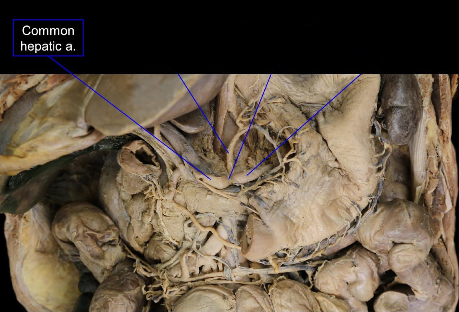 <p>A). Common hepatic artery<br>B). celiac trunk of the abdominal aorta</p>