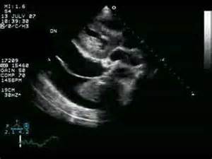 <p>What diagnosis can&nbsp;be made from this echo image?</p><ul><li><p>Normal parasternal long axis</p></li><li><p>Pericardial effusion</p></li><li><p>Pericardial and pleural effusion</p></li><li><p>Pleural effusion</p></li></ul><p></p>