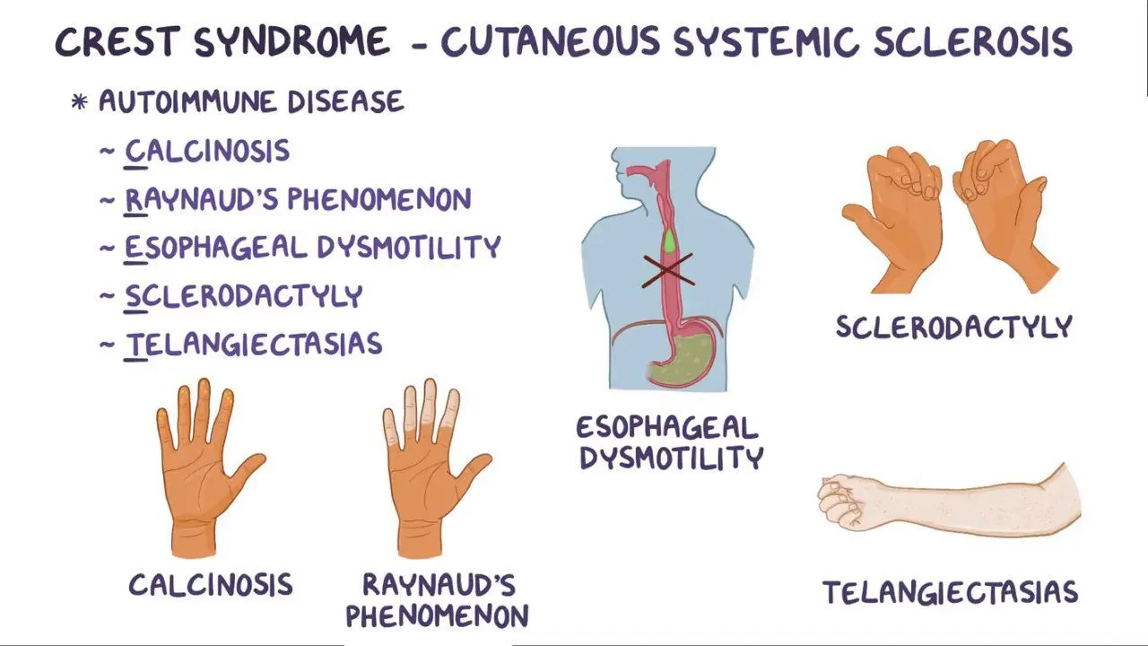 <p>Difference between limited vs. disseminated: <br><span>LcSSc (CREST syndrome) is more common and only peripheral skin is affected with slower progression of disease and later involvement of internal organs. </span></p><p><span>DcSSc affects truncal as well as peripheral skin and progresses more rapidly.</span></p>