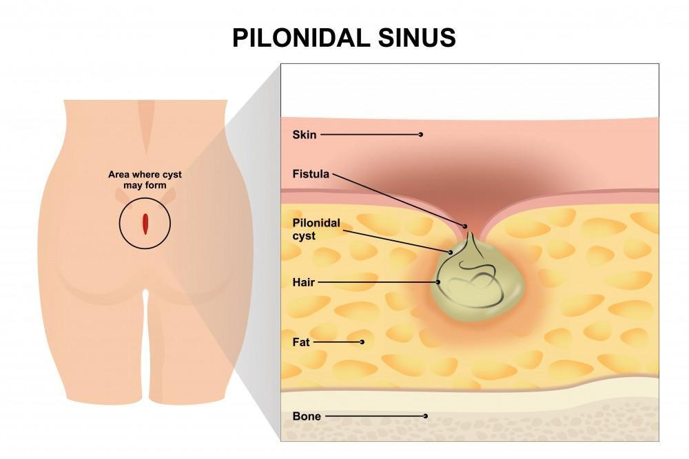 <p>PP: <span>hair follicles become blocked</span><span><span>→chronic infection of the skin in the cleft between the buttocks near the tailbone</span></span><br><span><span>associated with a sinus tract</span></span></p><p>E: men</p><p>CM: cyst in upper gluteal cleft<br>fragments of hairs</p><p>TX: colorectal surgery</p>