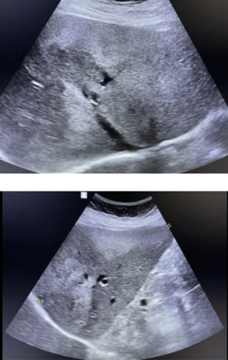 <p>d. Focal fatty infiltration</p>
