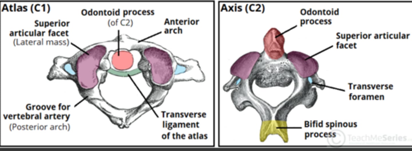 <p>• No vertebral body or disc</p><p>• Has anterior arch</p><p>• Has Anterior Arch Facet for Dens</p>