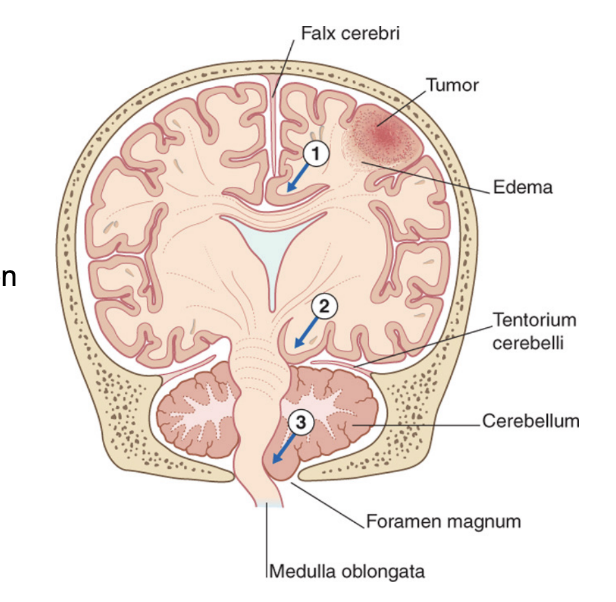 <ul><li><p><span>Structures of the posterior cranial fossa can herniate through the occipital foramen</span></p><ul><li><p><span>/Foramen magnum – mainly cerebellar tonsils, patient may die immediately due to compression of medulla oblongata</span></p></li></ul></li><li><p><span>Structures of the supratentorial compartment can herniate through the incisura tentorii&nbsp;</span></p><ul><li><p><span>Usually herniation of the temporal lobe – problems with oculomotor nerve, parasympathetic fibers inhibited, only sympathetic fibers work – the ones involved in pupil dilation (3rd cranial nerve)</span></p></li></ul></li></ul>