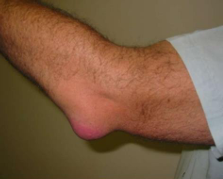 <p><u>Clinical Manifestations:</u> trauma/falling onto elbow, insidious onset (leaning on elbow for too long)</p><p><u>Management</u>: POLICE, aspiration, injection</p>