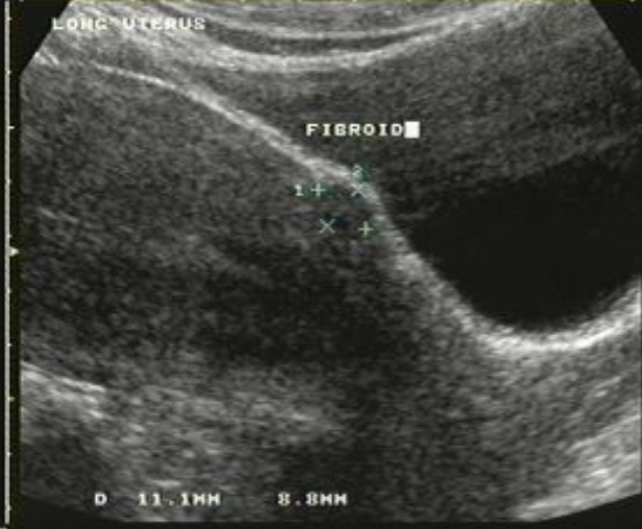 <ul><li><p>Located <u>within</u> the <span style="color: #0076ff">myometrium</span></p></li><li><p><span style="color: #ff0000">95% of fibroids located here</span></p></li><li><p>may enlarge to cause pressure on adjacent organs</p></li><li><p>may lead to <strong>infertility</strong></p></li></ul><p></p>