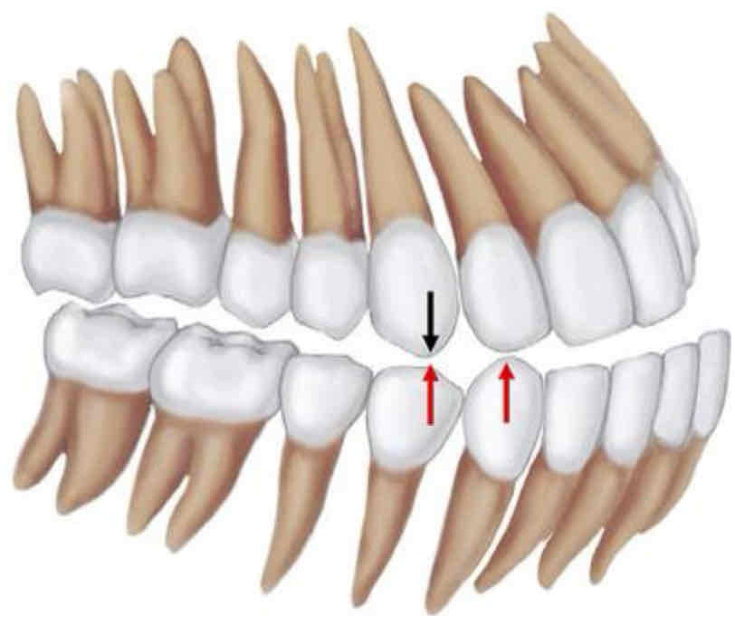 <p>class III occlusion</p>