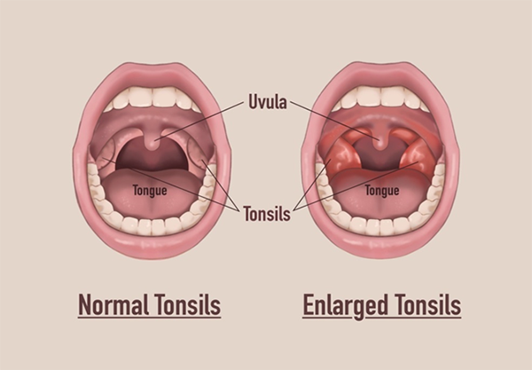 <p>Tonsil</p>