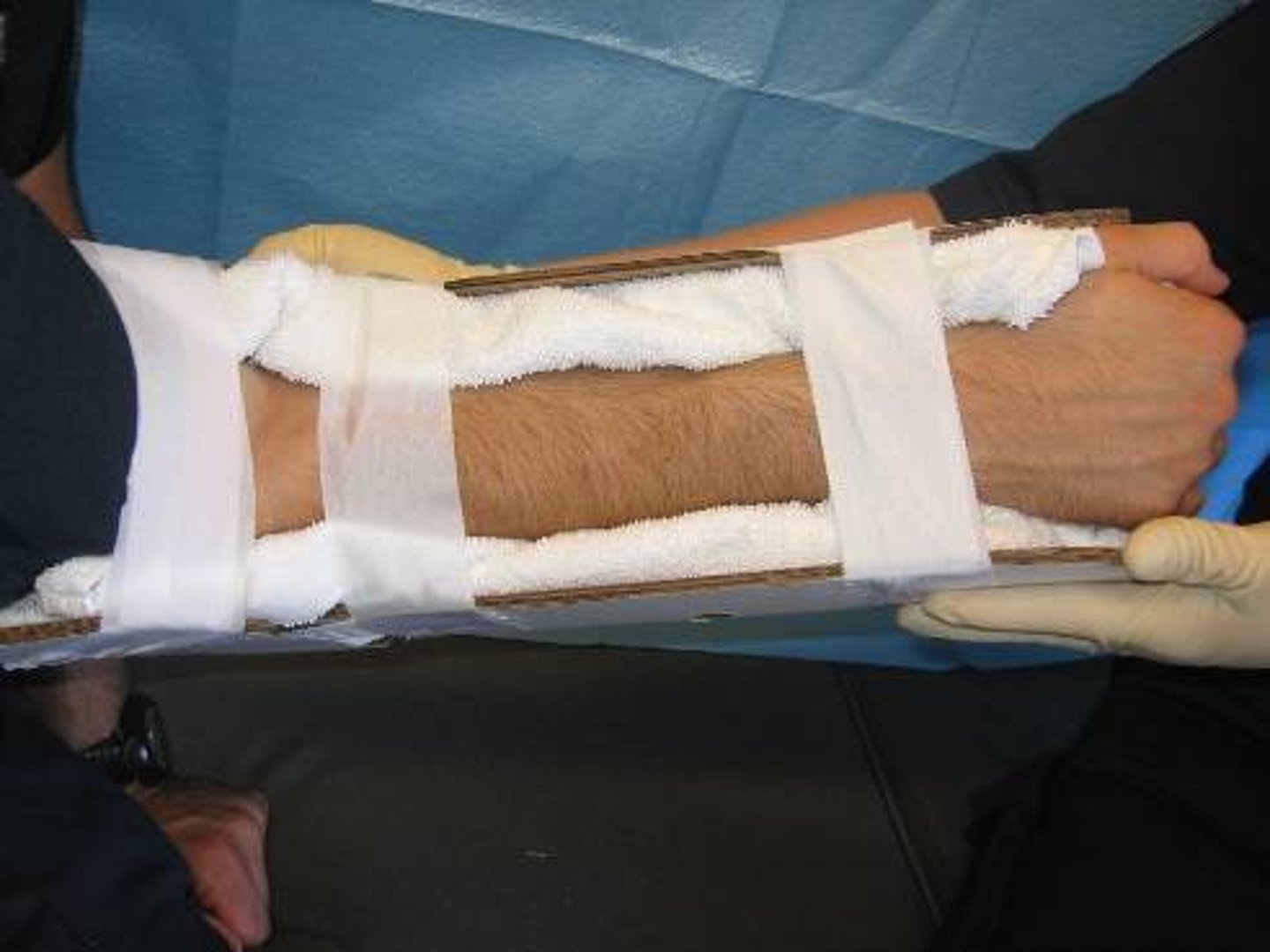 <p>device used to stabilize a body part</p><p>Used to reduce pain, prevent further damage of tissues surrounding fracture, reduce bleeding and swelling</p>