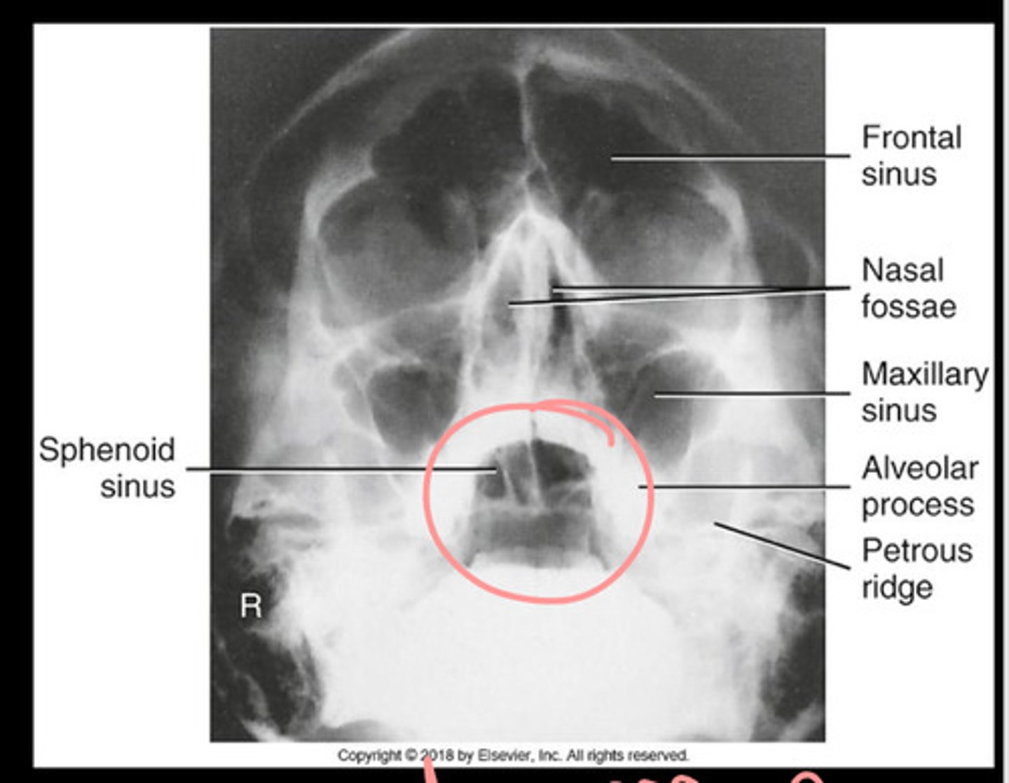 <p>Ethmoid and sphenoid sinuses</p>