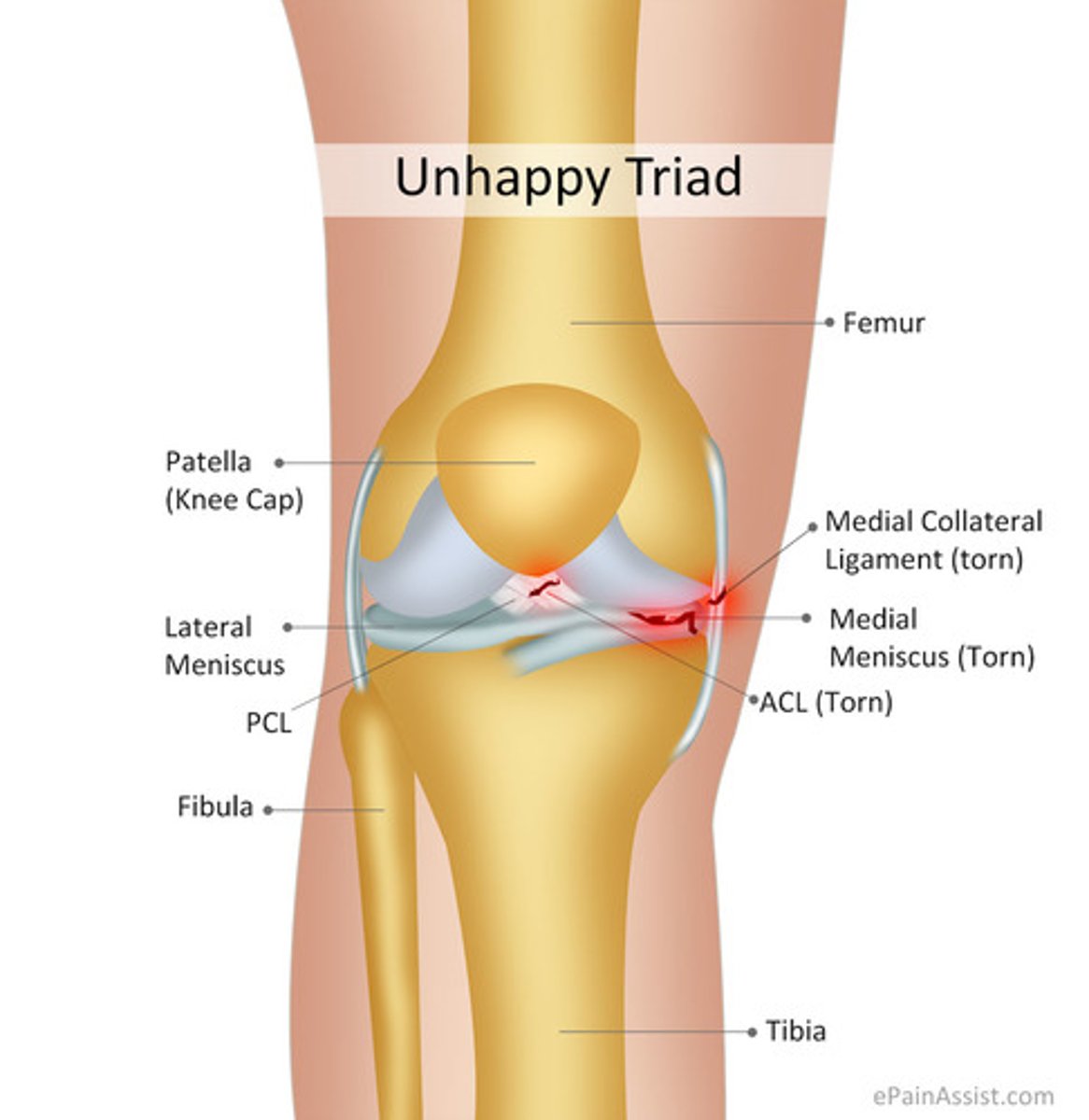 <p>ACL, MCL, meniscus tear</p>