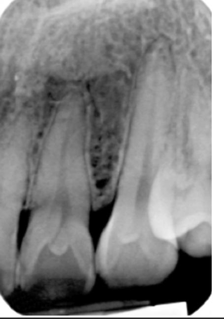 <p>42. What is seen in the radiograph (Fig. 5.28) on tooth #7?</p><p>a. Peg lateral</p><p>b. Dens in dente</p><p>c. Supernumerary tooth</p><p>d. Bifurcated root</p>
