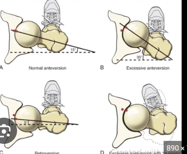 <p>The femoral neck decreases angle meaning the femoral head “leans backward” </p>