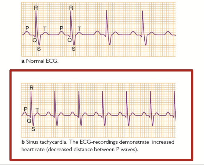 <p>Happens when the sinoatrial node sends impulses more quickly than normal. Can be triggered by exercise, caffeine, or stress.</p><p>Marked by decreased distance between P waves.</p>