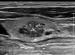 what thyroid pathology is shown here?

pts with hx of radiation are at increased risk; major spread is through lymphatic channels