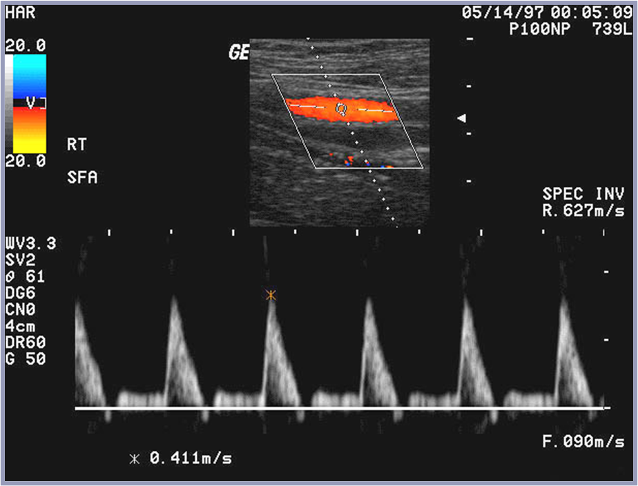 some spectral broadening with minimal reversal flow