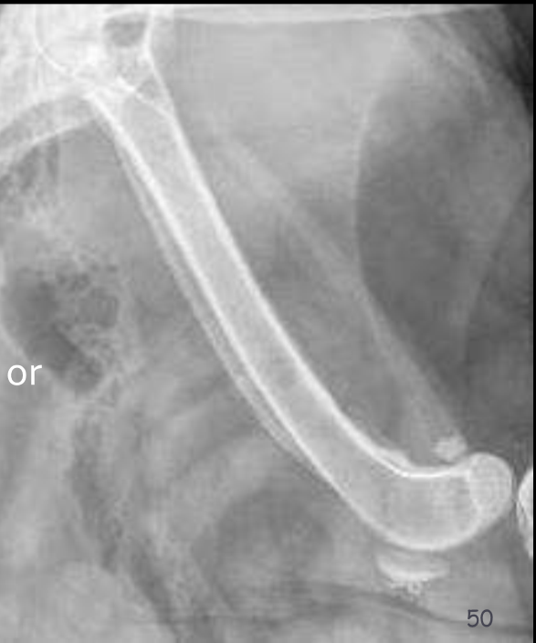 <p>What type periosteal reaction?</p>