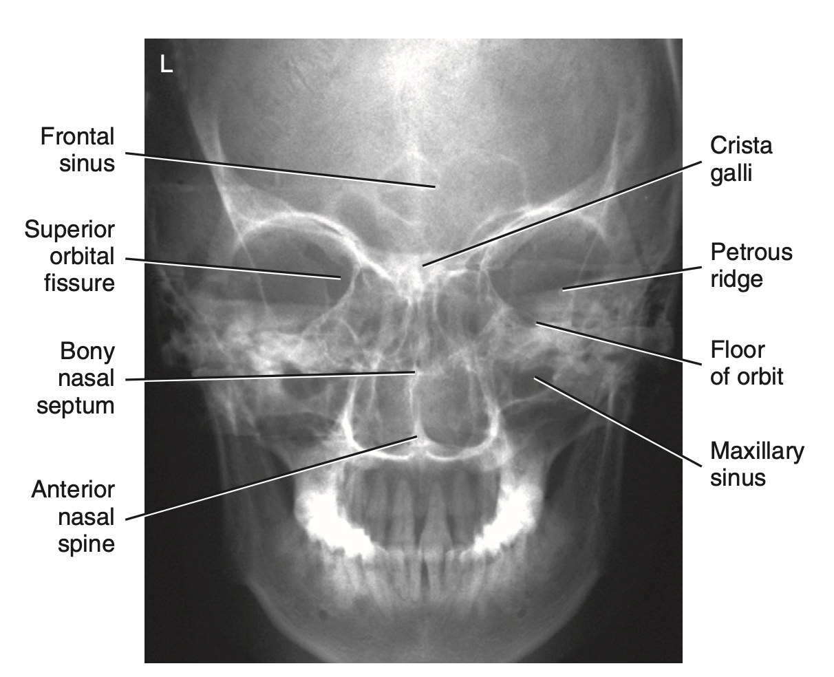 <p>How do you <u>critique</u> radiograph of <strong>PA axial projection: Caldwell method </strong>for <strong>facial bone</strong>?</p>
