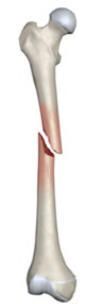 <p>What fracture is this?</p>