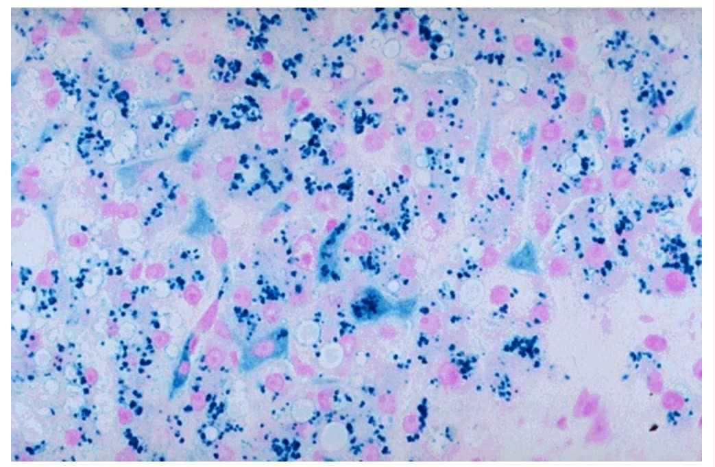 <p>Prussian blue reaction in this histological slide of the liver with iron stain. Identify the pink pigments found in the cytoplasm of the hepatocytes and the Kupffer cells.</p>