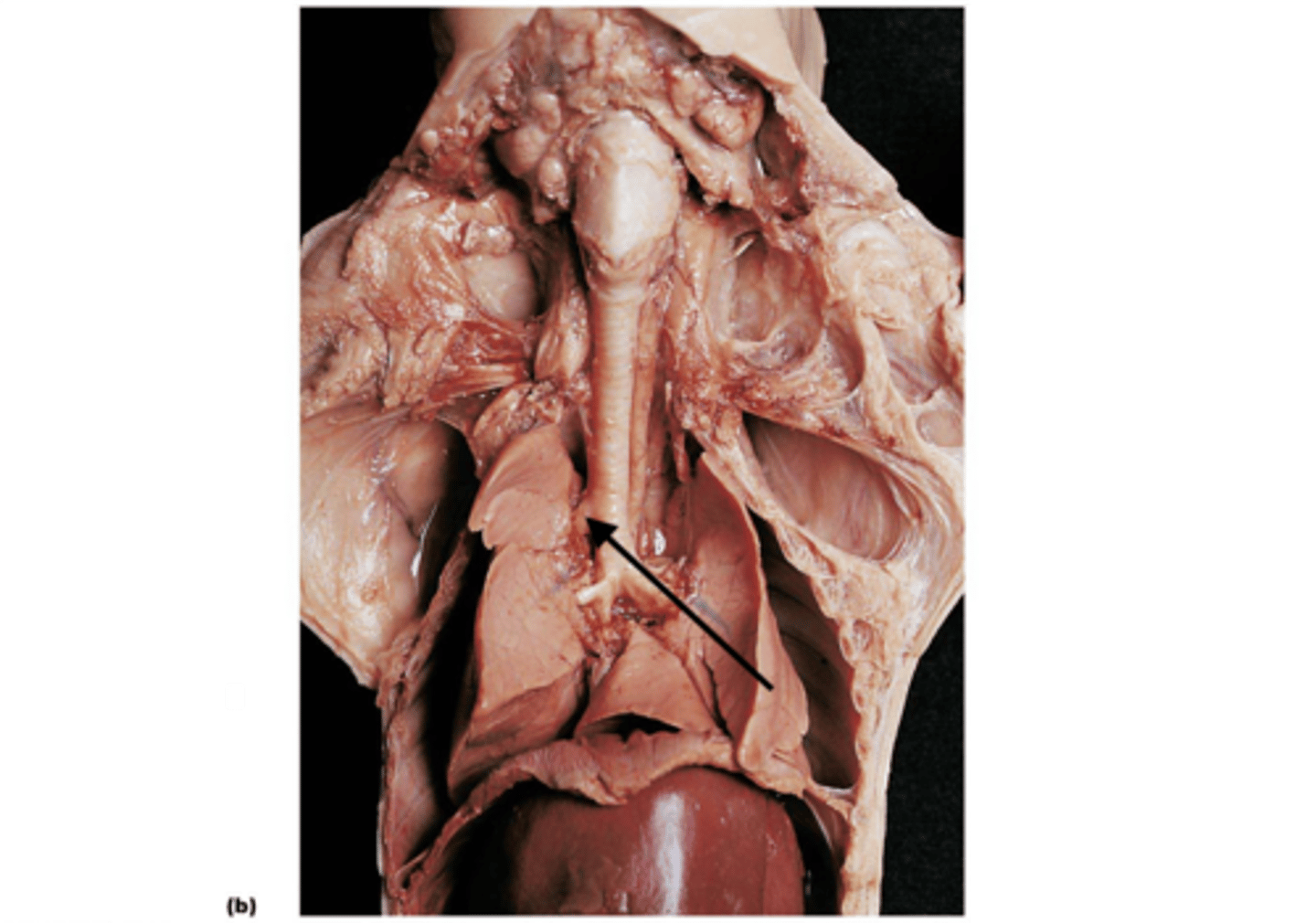 <p>Apical bronchus</p>