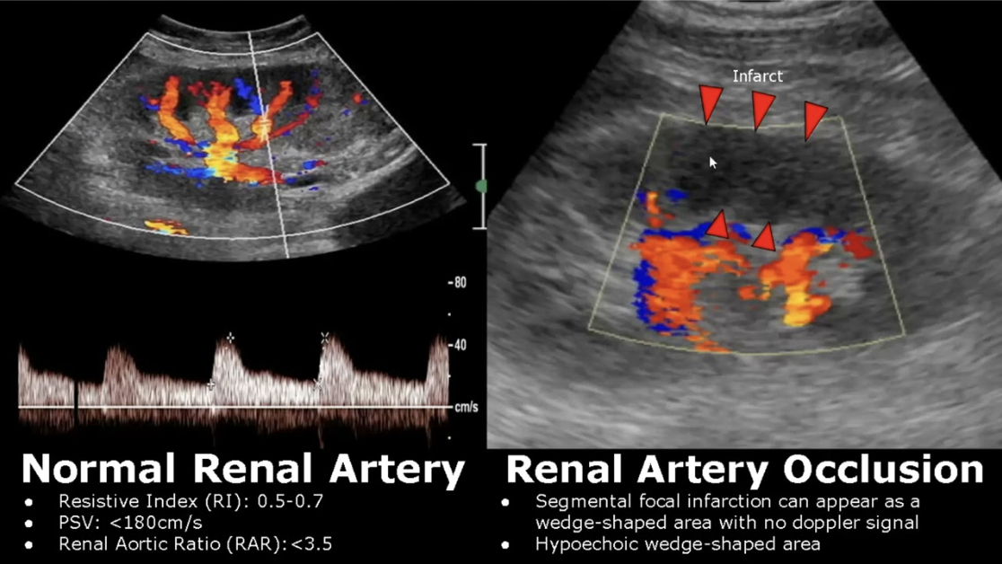 <p>Ultrasound image + Doppler</p><p>Determine occlusion site + severity</p>
