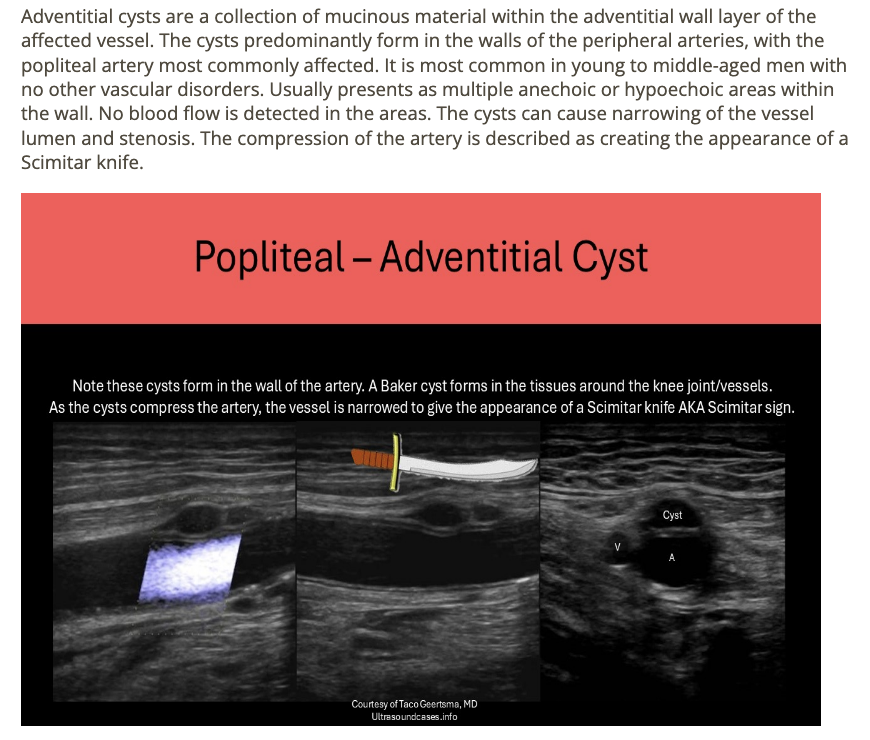 <p>c) adventitial cyst </p>