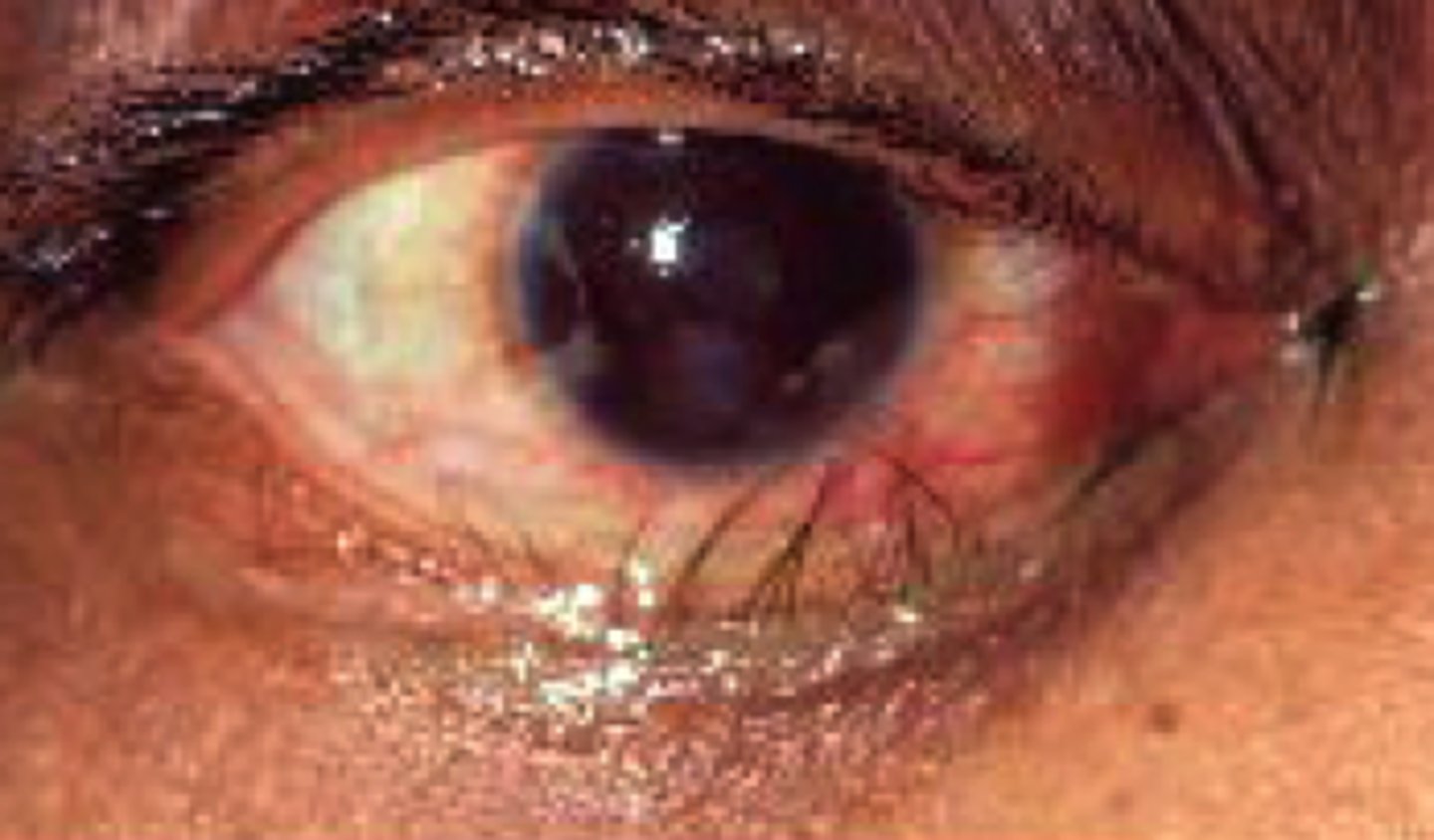 <p>misdirected eyelashes that rub on the conjunctiva or cornea</p>