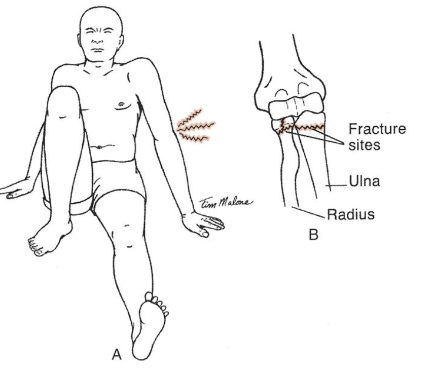 <p><span data-name="black_small_square" data-type="emoji">▪</span> Tête radiale</p><p><span data-name="black_small_square" data-type="emoji">▪</span> Processus coronoïde de l’ulna</p><p>N.B. Il peut avoir fracture de ces structures osseuses si la pression exercée dépasse la résistance de l’os.</p>