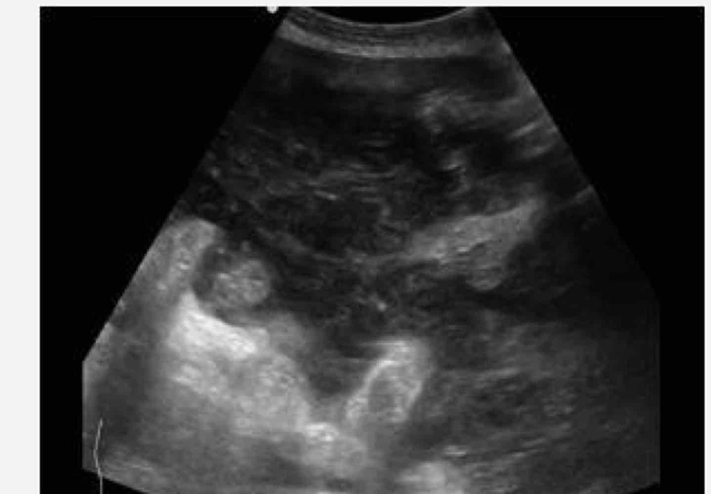 <p>accumulation of mucinous material in the peritoneal cavity </p>