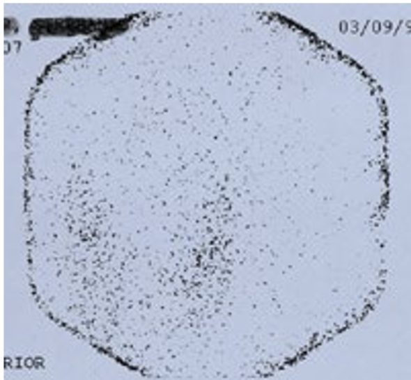 <p>What does this show in what disease</p>