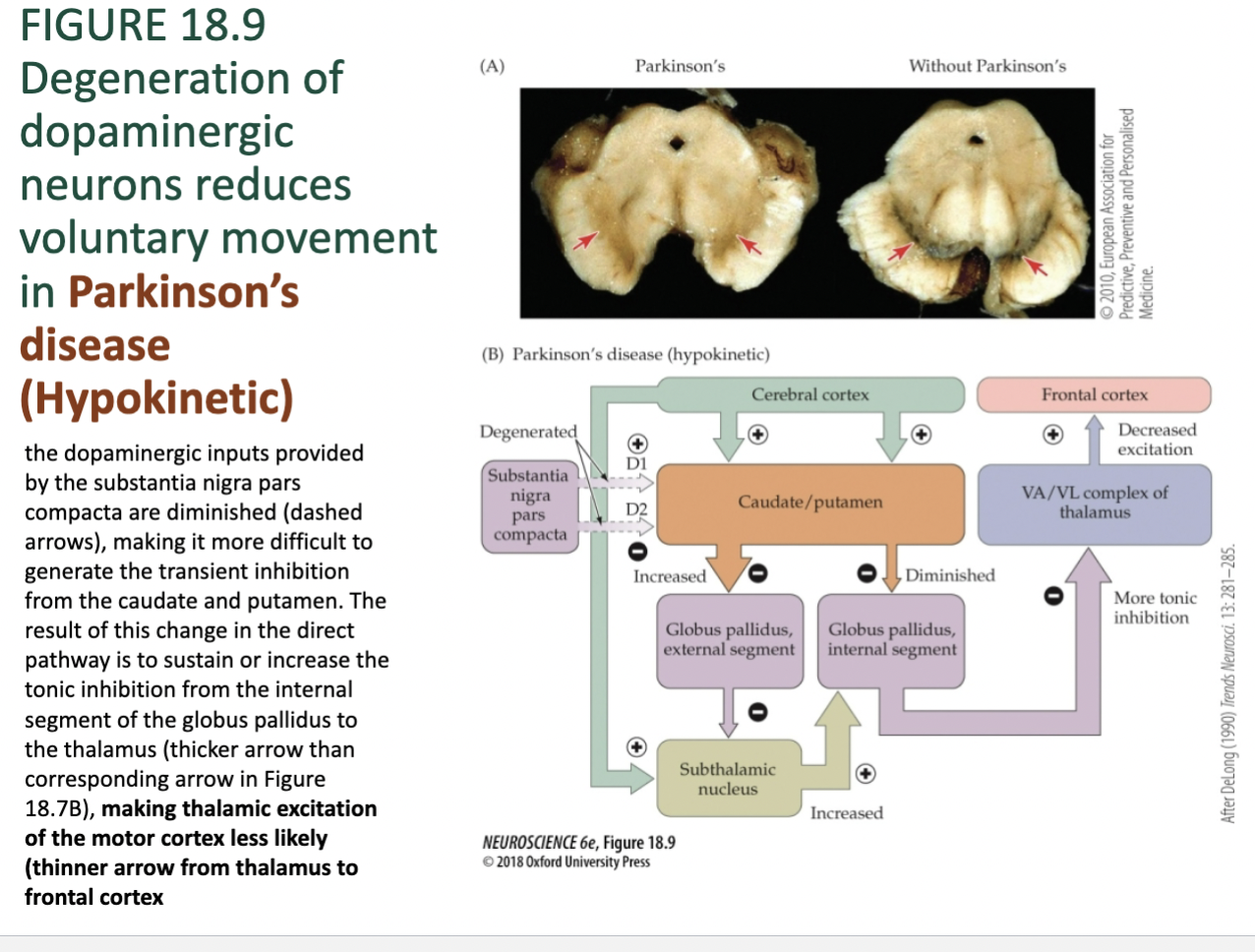 <p><span>Figure 18.9- Neuropathology of Basal Ganglia –  Parkinson’s </span></p>
