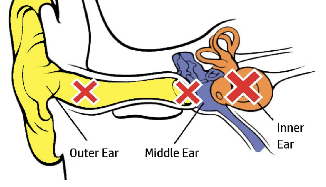 <p>What kind of hearing loss is this?</p>