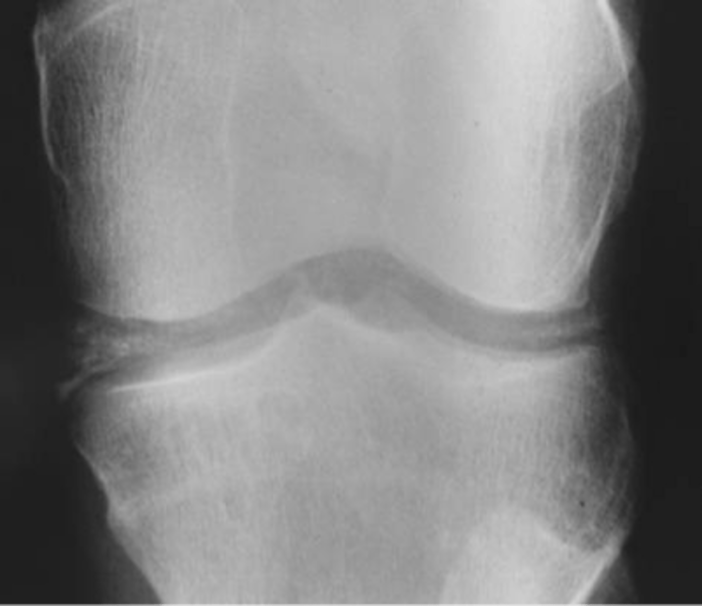 <p>State the target sites of calcium pyrophosphate dihydrate crystal deposition disease (CCPD)</p>