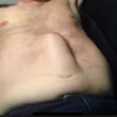 <p>= midline longitudinal ridge that is a separation of the abdominal rectus muscles (occurs congenitally and as a result of pregnancy and marked obesity)</p>