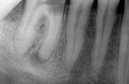 <p><strong>Osteitis</strong></p>